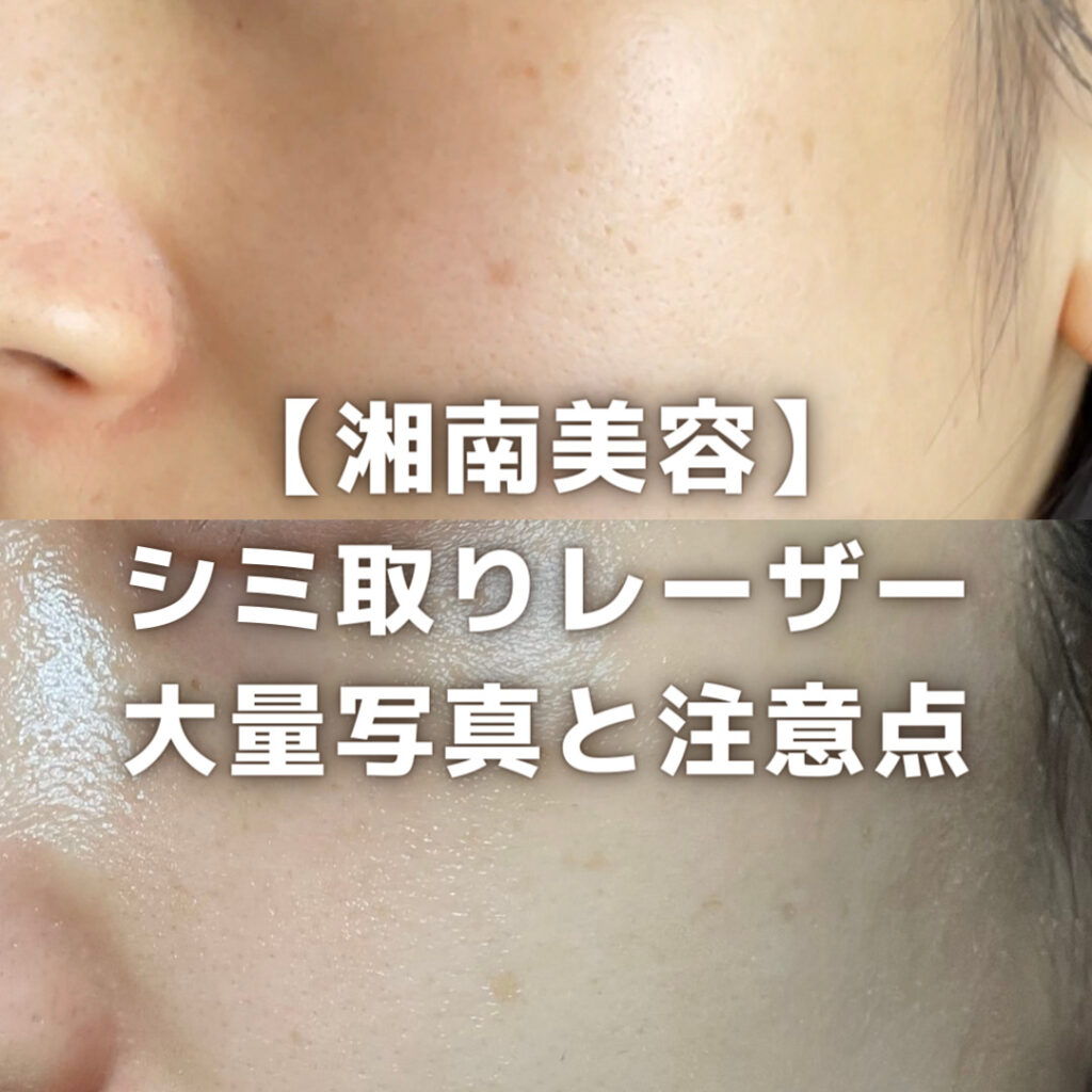 【シミ取り】ルメッカで薄いシミに効果やばい！口コミレビューダウンタイムや料金と経過レポ 【2023年8月】