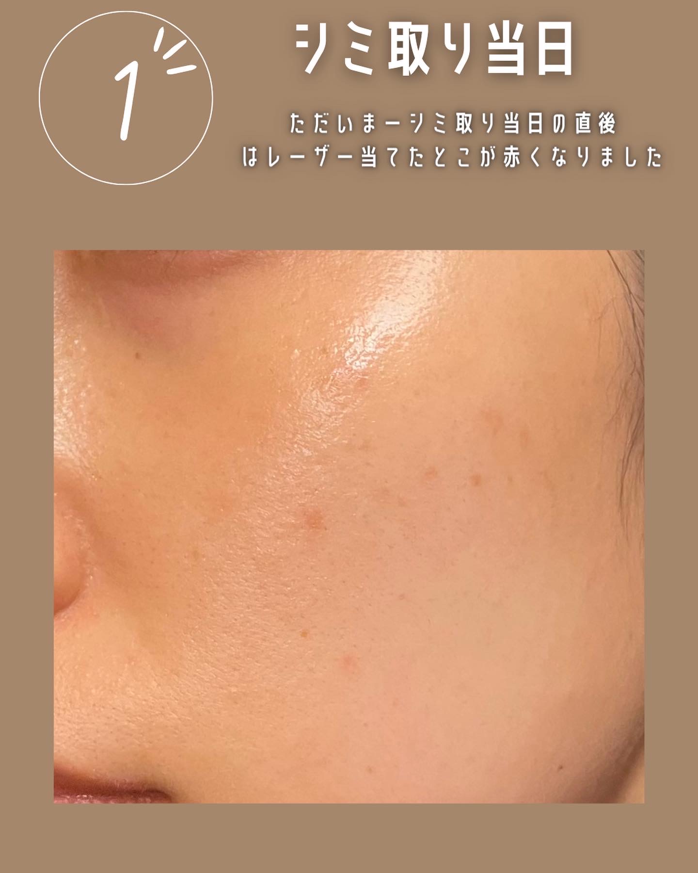 【シミ取り10】湘南美容外科でシミ取りレーザー経過と注意点！失敗？