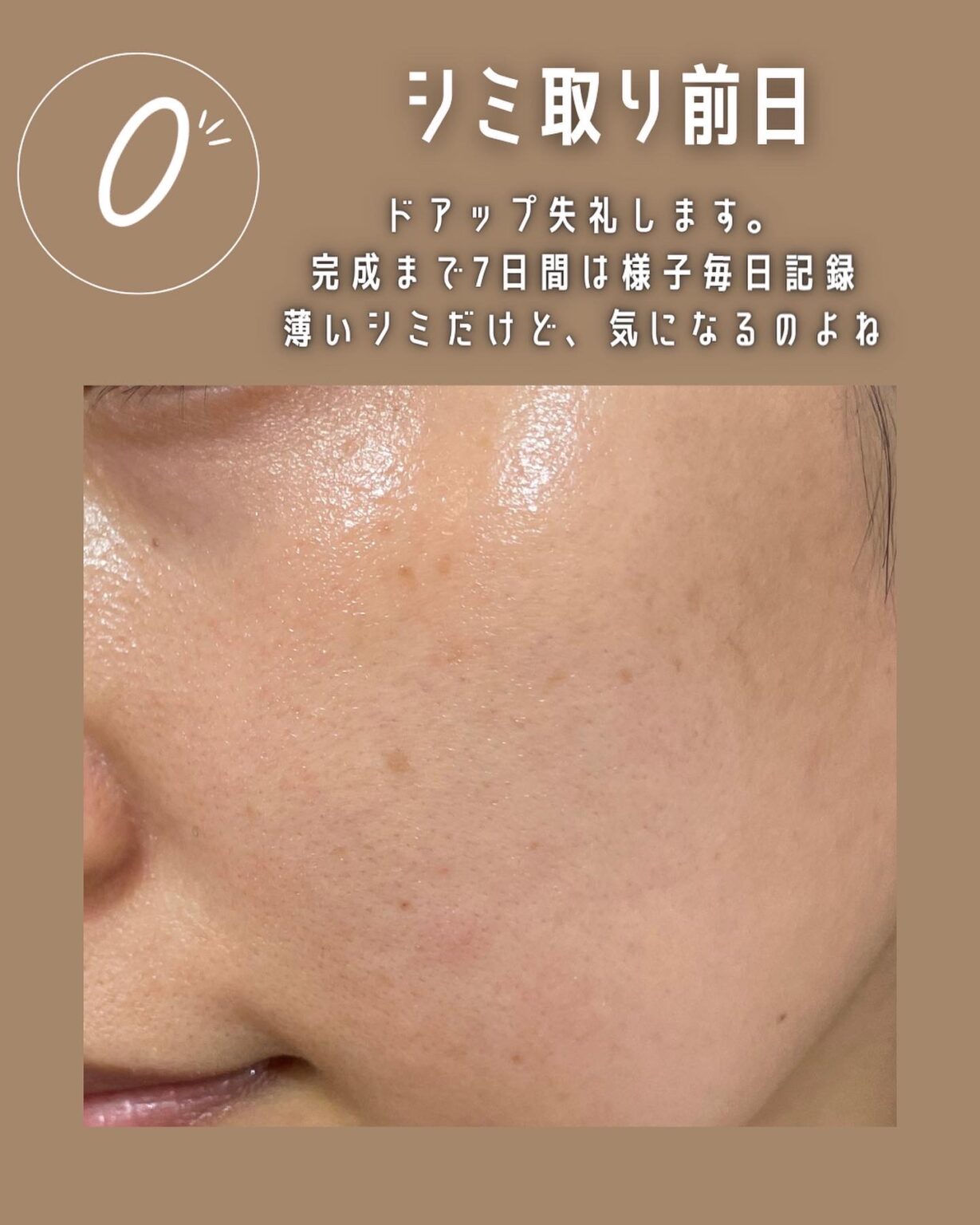 【シミ取り10】湘南美容外科でシミ取りレーザー経過と注意点！失敗？